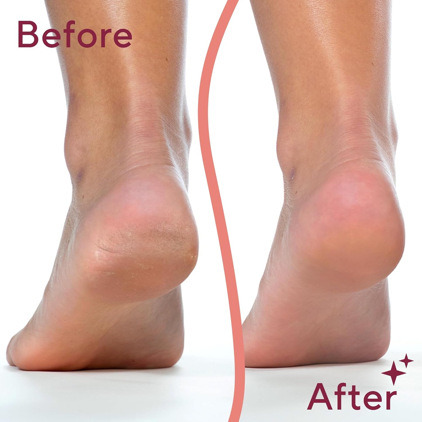 Electric Callus and Dead Skin Remover